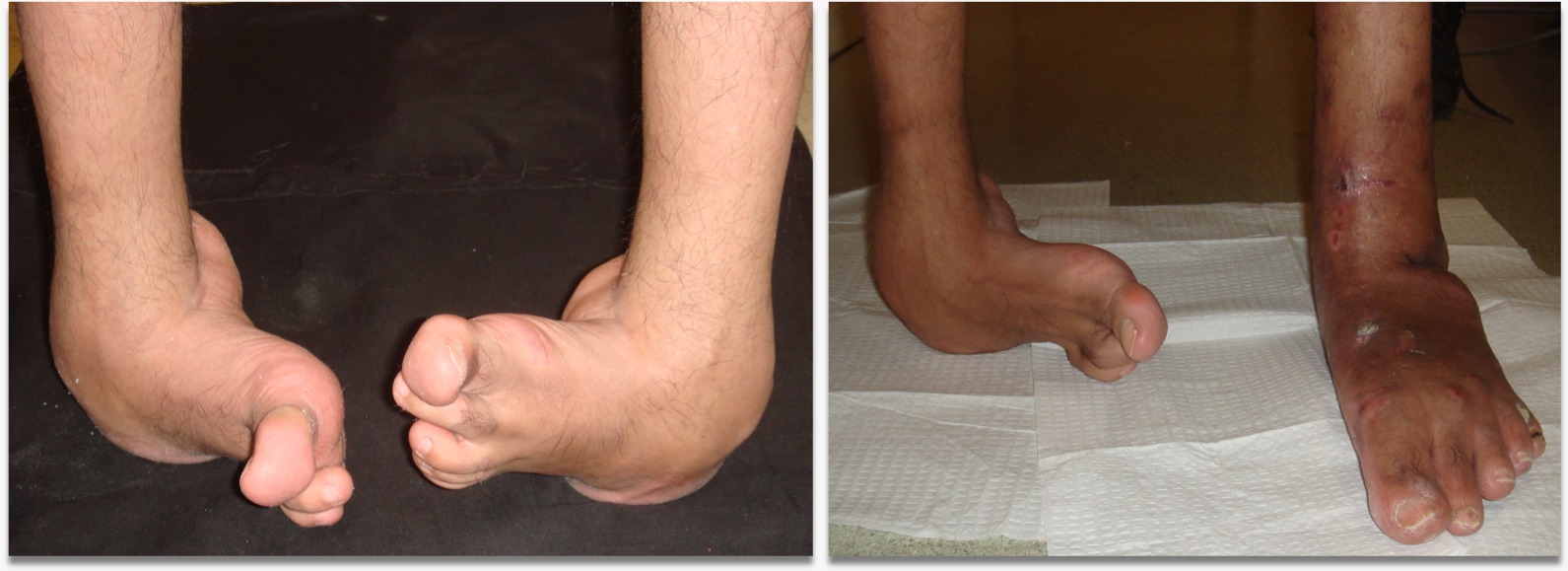 Pasien Kaki Pengkor Berjalan Kembali Setelah 20 Tahun Terapi